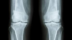Quiz - Testez vos connaissances sur l’ostéoporose