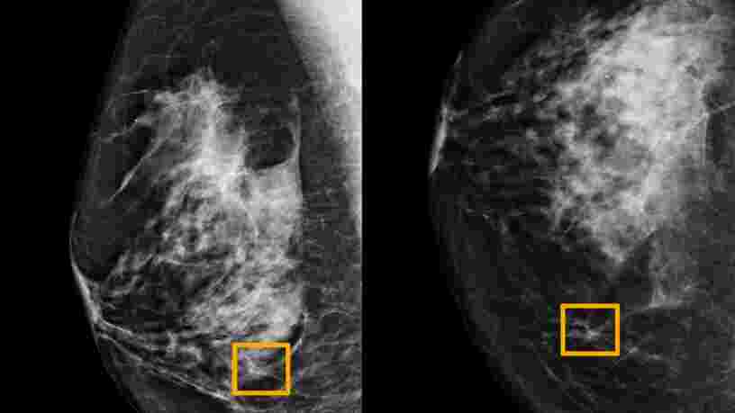 DeepMind de Google a créé une IA qui détecterait le cancer du sein mieux que les radiologues humains