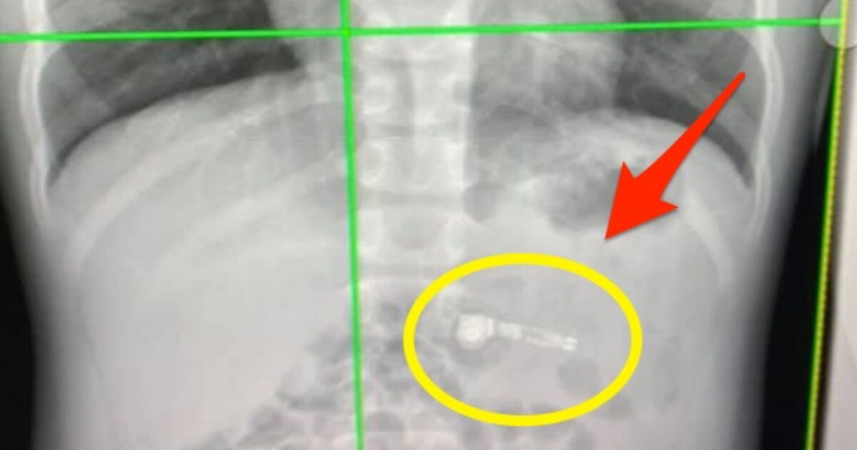 A 7yearold was taken to the hospital after swallowing an AirPod