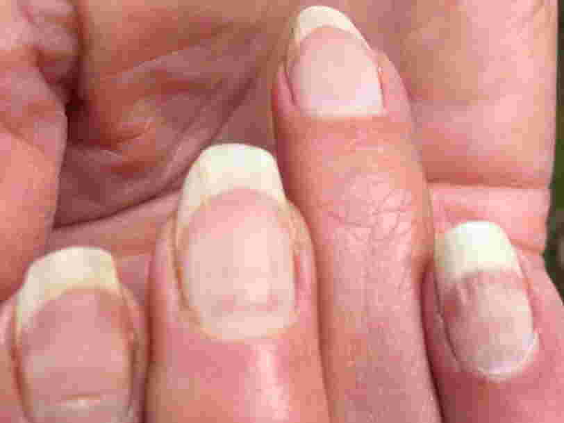 People Are Getting Covid Nails And One Expert Says The Unusual Lines Could Be As Useful