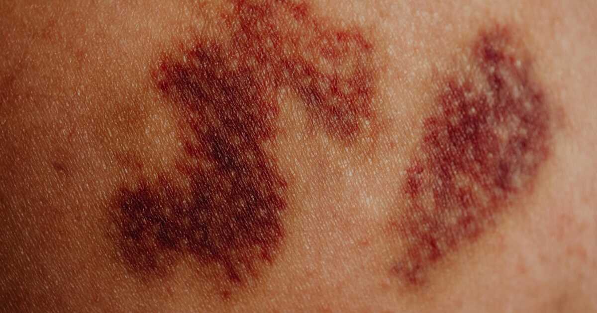Comment faire disparaître une cicatrice ?