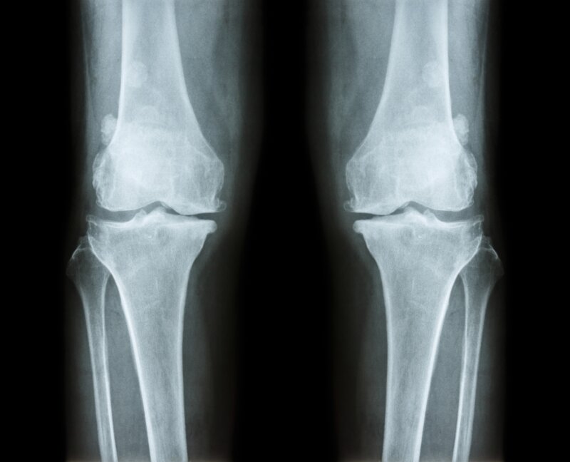 L’ostéoporose touche exclusivement les femmes