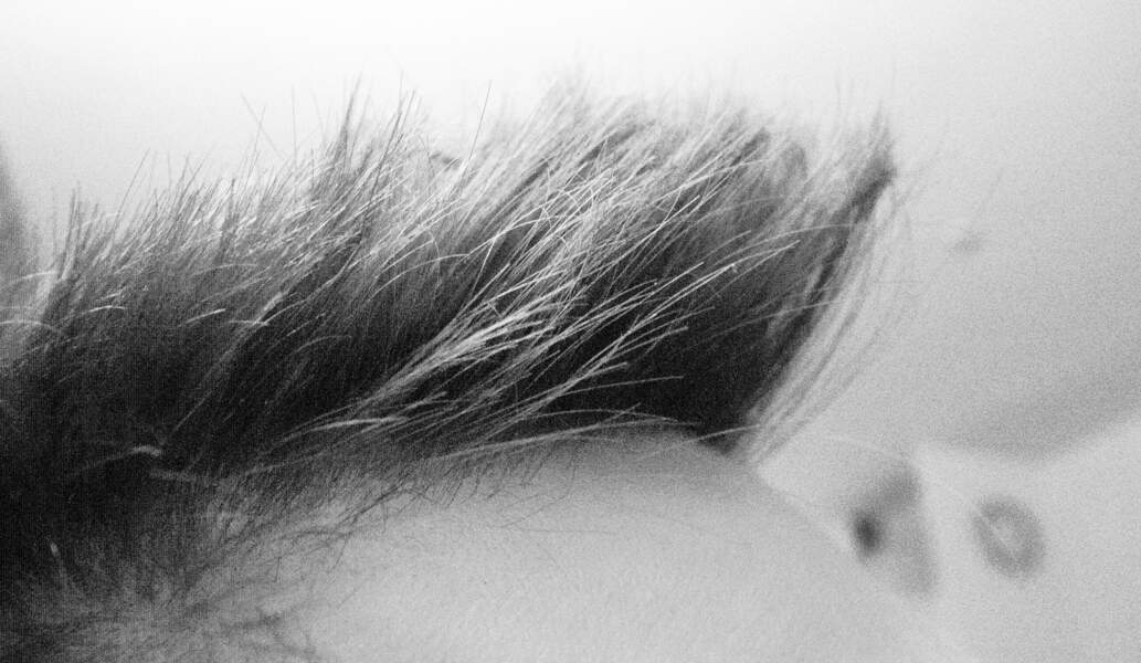 13 • Une perte de cheveux