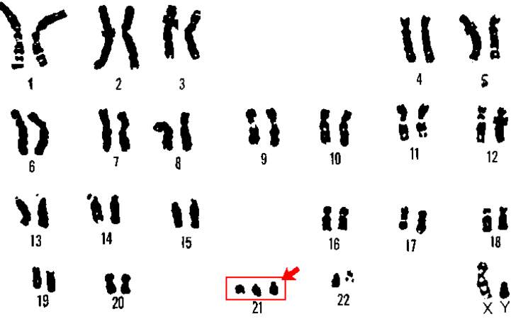 Marthe Gautier, elle a découvert le troisième chromosome 21 