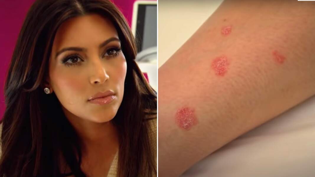 Kim Kardashian souffre de psoriasis